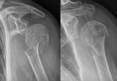 Shoulder-X-ray